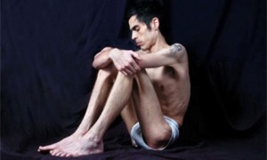 Cada vez es mas frecuente la anorexia en hombres a pesar que antes se consideraba exclusiva de las mujeres