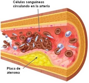 La placa por si misma puede no causar una obstrucción total hasta que se desprende o se produce una trombosis sobre ella