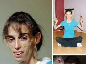 Kate Chilver uno de los casos peores de anorexia conocidos