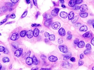 En los casos de cancer diferenciado, los patólogos tienen dificultad para diferenciarlos de un nódulo benigno