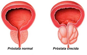 creciiento-prostata