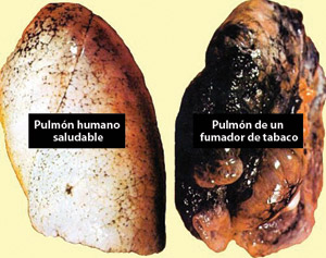 A la izquierda puedes ver un pulmón normal y a la derecha uno de un fumador severo. Puedes notar la diferencia