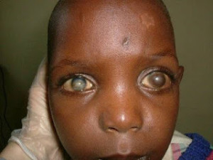 La xeroftalmia es todavía la causa más frecuente de ceguera adquirida en niños y adolescentes
