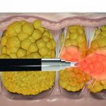 El Laser micro-invasivo es una alternativa actual para destruir los septos que forman la celulitis 